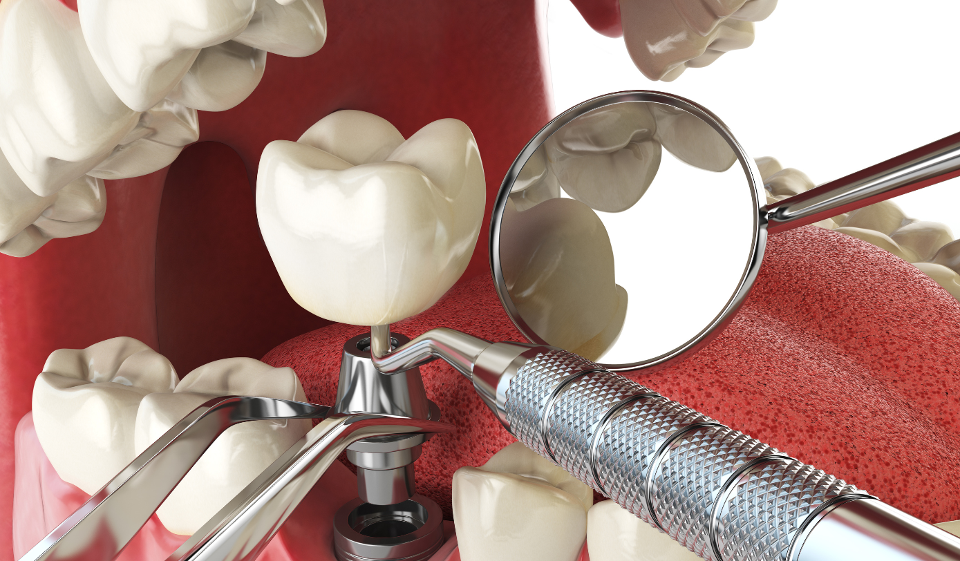 Dental Implant Service