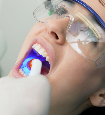 Dental Filling