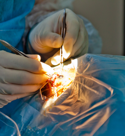 Cataract Surgery